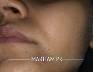 Face- Big Hard Pimple 