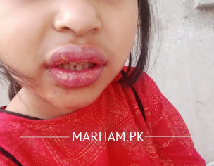 Swollen Lips