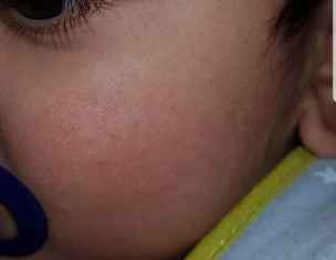 Cheeks Redness