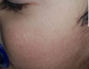 Cheeks Redness