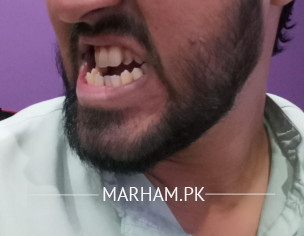 Open Bite