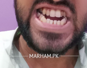 Open Bite