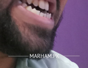 Open Bite