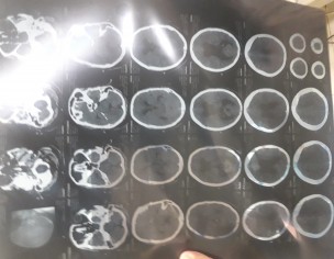 Neuro Problem 