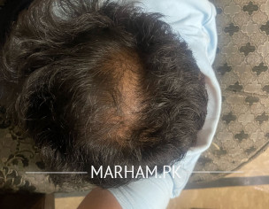 Hair Fall Issues