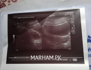 Conceive Prblm