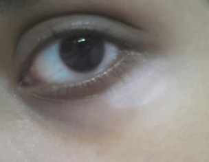 White Patch Under One Eye