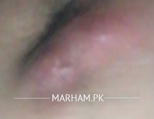 Underarm Lump