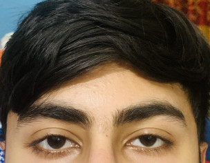 Ptosis Or Something