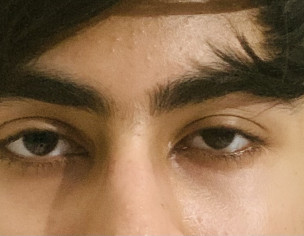 Ptosis Or Something