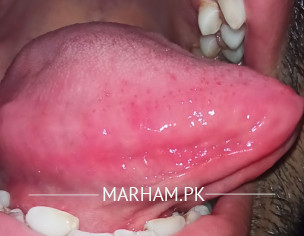 Tongue Problem