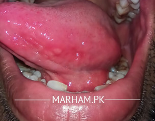 Tongue Problem