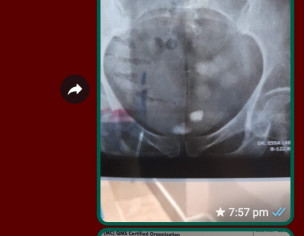 Urinary Bladder Stone