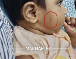 Dark Patch On Face