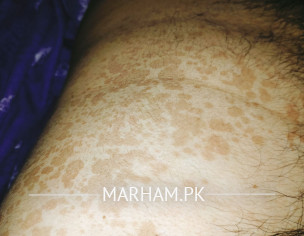 Pigmentation Or Something Else