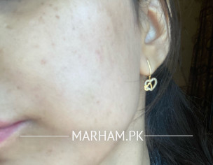 Face Skin Problem