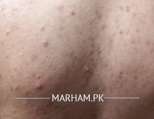 Acne In Back