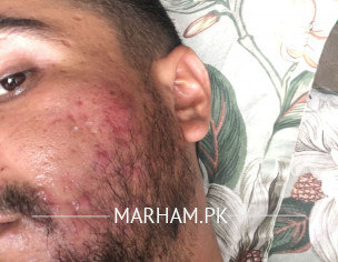 Red Acne & Itching 