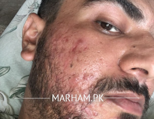 Red Acne & Itching 