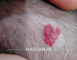 Haemengioma
