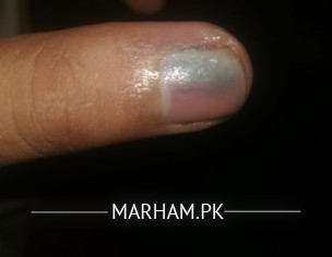 Injury