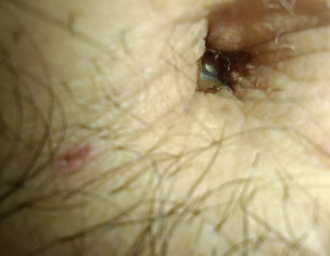Belly Button
