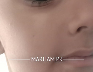 White Spot On Face