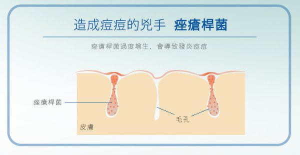 簡單保養,植萃淨荳精華,抗痘,痘痘肌,油性肌,試用,體驗