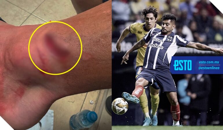 Corona mostró su herida en redes sociales