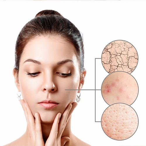 Acne Scars Treatment image