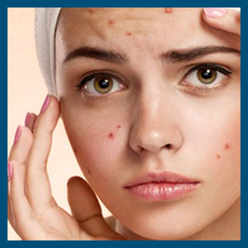 Acne Facial image