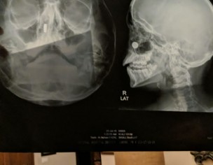 Inhaled Button Battery