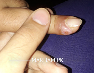 Finger Problem