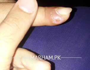 Finger Problem