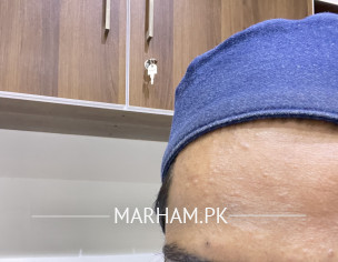 Forehead And Neck Acne Prb