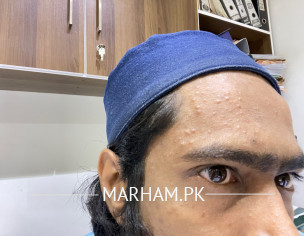 Forehead And Neck Acne Prb