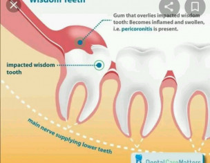 Dental Problem