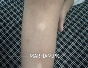 White Patch On Eyelid And Legs