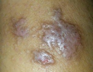 Dry Patch On Skin.