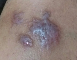 Dry Patch On Skin.
