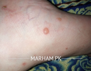 Skin Allergy And Liver Problem