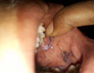Mouth Ulcer