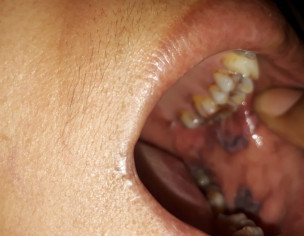 Mouth Ulcer