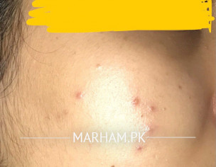 Skin Acne Issue