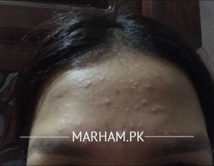 Skin Acne Issue