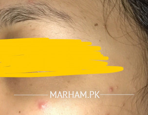 Skin Acne Issue