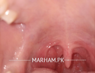 One Side Tonsils Bump