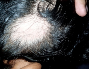 Balcher/Alopecia Areata