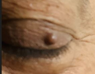 Solid Pimple On Eye Lid