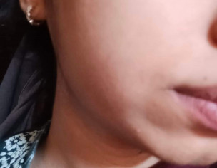 Little Pimples On Face